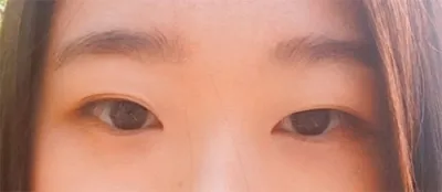 非切開埋線雙眼皮手術後記！