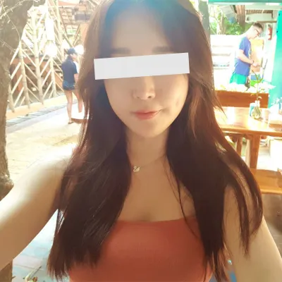 ★顴骨縮小術1年半後記★