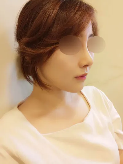 鼻樑、鼻尖、下巴植入物、維納斯雷射