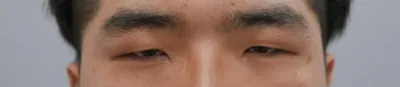 雙眼皮（切開）、眼型矯正、開眼頭