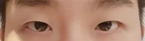 男生眼部整形10天~後記（眼部矯正（非切割）、開眼頭）