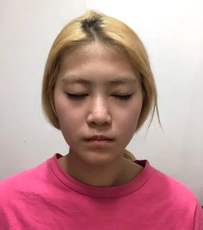 在 Jayjun 整形外科手術已經 3 個月了！！