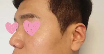 鼻樑、鼻頭、蒜頭鼻矯正、鷹鉤鼻