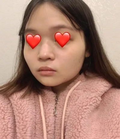 做了臉部輪廓+鼻子整形已經3個多月了！