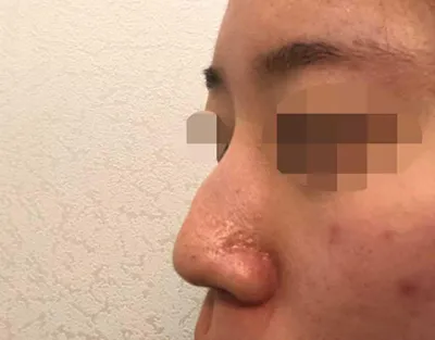 手術後4個月的後記!! ᄒᄒᄒ