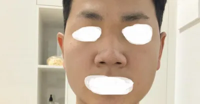 大家好，我做完隆鼻手術已經一週了
