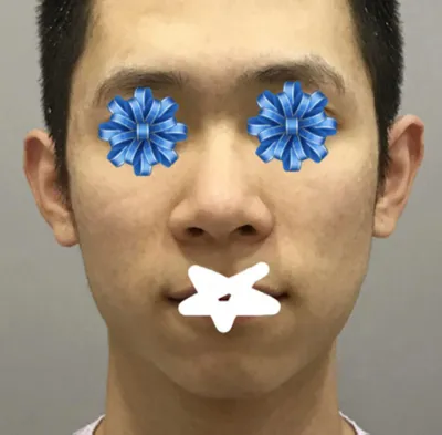 男士鼻子、輪廓整形後記