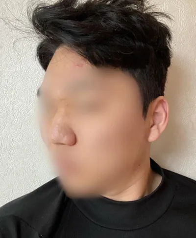 墊高鼻樑、鼻頭、蒜頭鼻矯正、鼻骨縮小