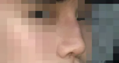 鼻樑、鼻尖、駝峰鼻、鼻骨縮小