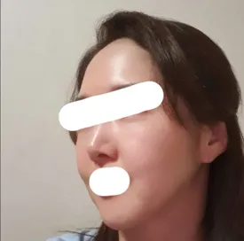 做了顏面拉皮重做手術，看到以前的照片很滿意^^