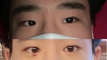 雙眼皮（縫雙眼皮）, 開眼頭