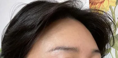 額頭脂肪移植