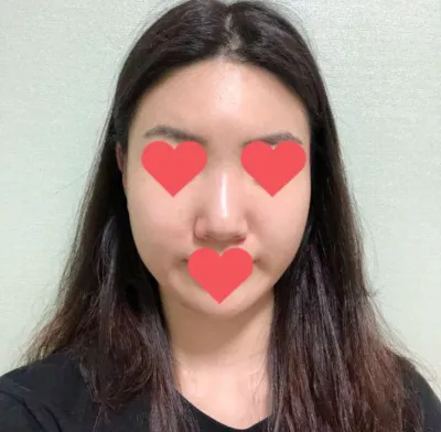 隆鼻手術2年後記