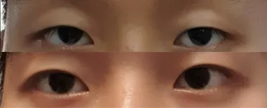#非切開眼部整形