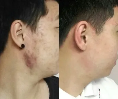 痘痘治療6個月後記