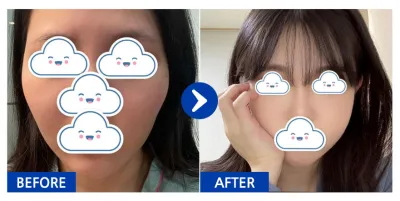 [Babytalk] 臉部輪廓 / 術後3個月 / 暱稱：orini_