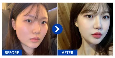 [Babytalk] 臉部輪廓、雙眼皮、鼻整形 / 7個月 / 暱稱：雪允2