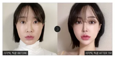 [江南姐姐心得] 國字臉、下巴整形滿一個月 / 暱稱：熊熊三兄弟