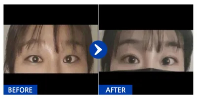 [Babitalk] 雙眼皮 / 第3個月 / 暱稱：tilia20