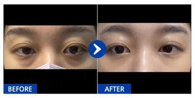 [Babitalk] 眼底脂肪重新配置 / 1個月 / 暱稱：눈눈엉옹