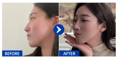 [Babytalk] 隆鼻 / 5個月 / 暱稱：atmospe