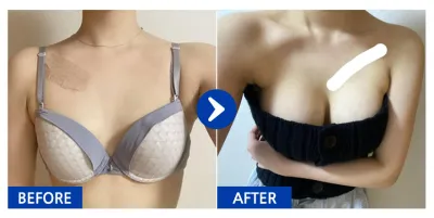 [Babitalk] 隆乳 / 6個月 / 暱稱：Melyong