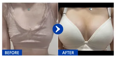 [Babitalk] 隆乳手術 (Sebbin) / 術後5個月 / 暱稱：Hyonni-hyonni-ya