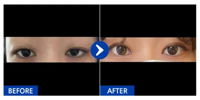 [江南姐姐] 雙眼皮 (自然黏連) / 第2週 / 暱稱：눈누난마난