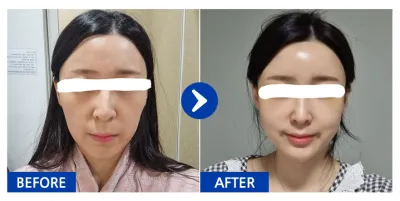 [Babitalk] 脂肪移植 / 1個月 / 暱稱：요요몬a