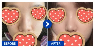 [江南姐姐] 隆鼻 / 術後1個月 / 暱稱：yyjk3396