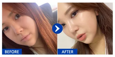 [Babitalk] 隆鼻 / 術後6個月 / 暱稱：閃亮加兒