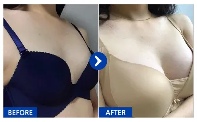 [Babitalk] 隆乳手術 / 第5個月 / 暱稱：Jeong-ssyu-gi