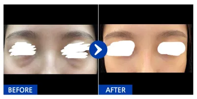 [Babitalk] 眼下脂肪重新配置 / 1個月 / 暱稱：咻咻咻咻咻