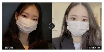 [江南姐姐心得] 眼部整形一個月 / 暱稱：我眼是你眼