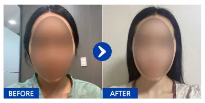 [Babitalk] 臉部輪廓 / 術後1個月 / 暱稱：윰대딩