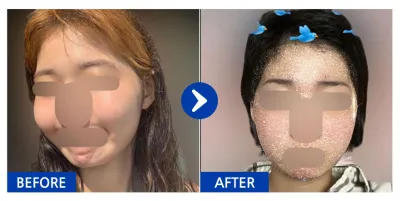 [Babitalk] 面部輪廓 / 術後1個月 / 暱稱：이이으루루루