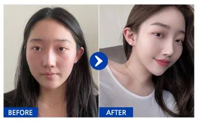 [Babitalk] 鼻整形（功能鼻+美容鼻）/ 2個月 / 暱稱：atmospe_