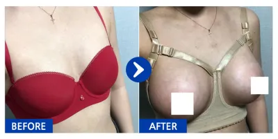 [Babitalk] 隆乳手術 / 第2週 / 暱稱：Amy姊姊