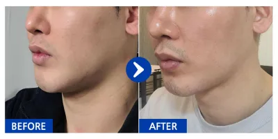 [Babitalk] 臉部抽脂 / 第2個月 / 暱稱：굼붕어