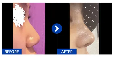 [江南姐姐] 鼻 / 1個月 / 暱稱：kirakira.s