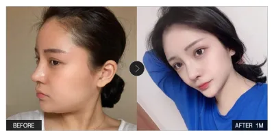 [江南姐姐評價] 臉部抽脂滿一個月 / 暱稱：棉花糖Mogu