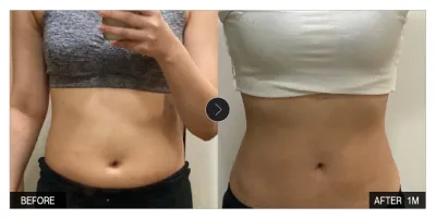 [江南姐姐評價] 抽脂第1個月 / 暱稱：棉花糖Mogu