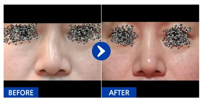 [Babytalk] 隆鼻 / 術後1個月 / 暱稱：Superchu