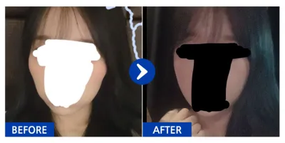 [江南姐姐] 顴骨 / 1個月 / 暱稱：都是大小眼的錯;