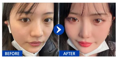 [江南姐姐] 眼底脂肪重新配置 / 第6個月 / 暱稱：志願是江南美人