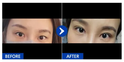 [江南姐姐] 自然黏連 (雙眼皮) / 第2週 / 暱稱：달벙잉