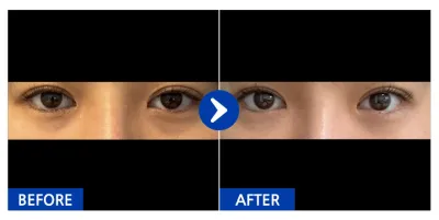 [江南姐姐] 眼底脂肪重新配置 / 滿1個月 / 暱稱：OooO와