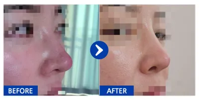 [Babitalk] 隆鼻修復 / 術後1個月 / 暱稱：無尾熊琪琪