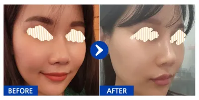 [Babitalk] 鼻部修復手術 / 術後1個月 / 暱稱：wane