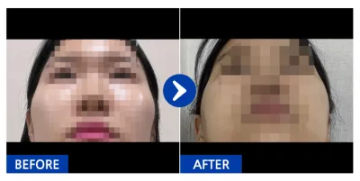 [江南姐姐] 臉部輪廓(顴骨) / 第3週 / 暱稱: beami